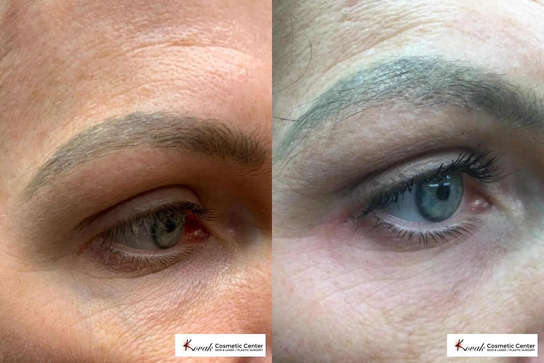 Eye Vein Treatment on a 39 year old female using the CoolTouch Varia - Before and After  