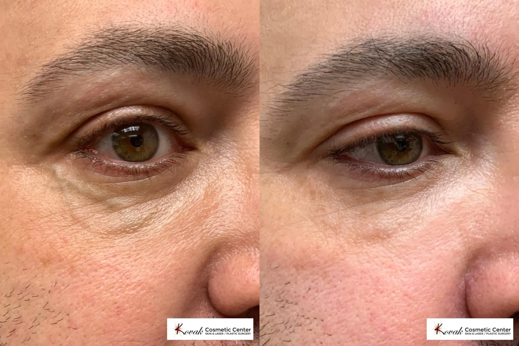 Laser treatment on a 49 yr old male to remove eye veins  - Before and After  