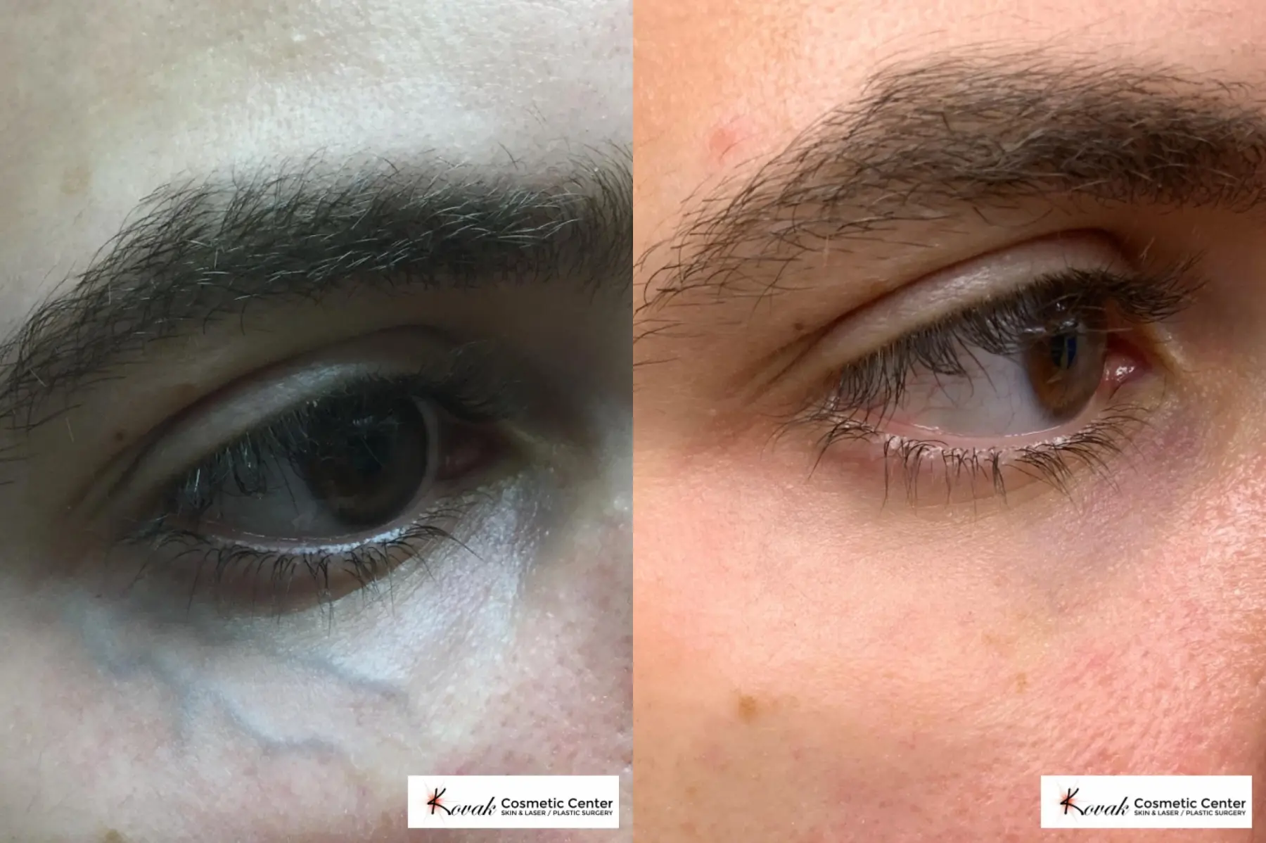 Eye Vein Treatment on a 33 year old male - Before and After  