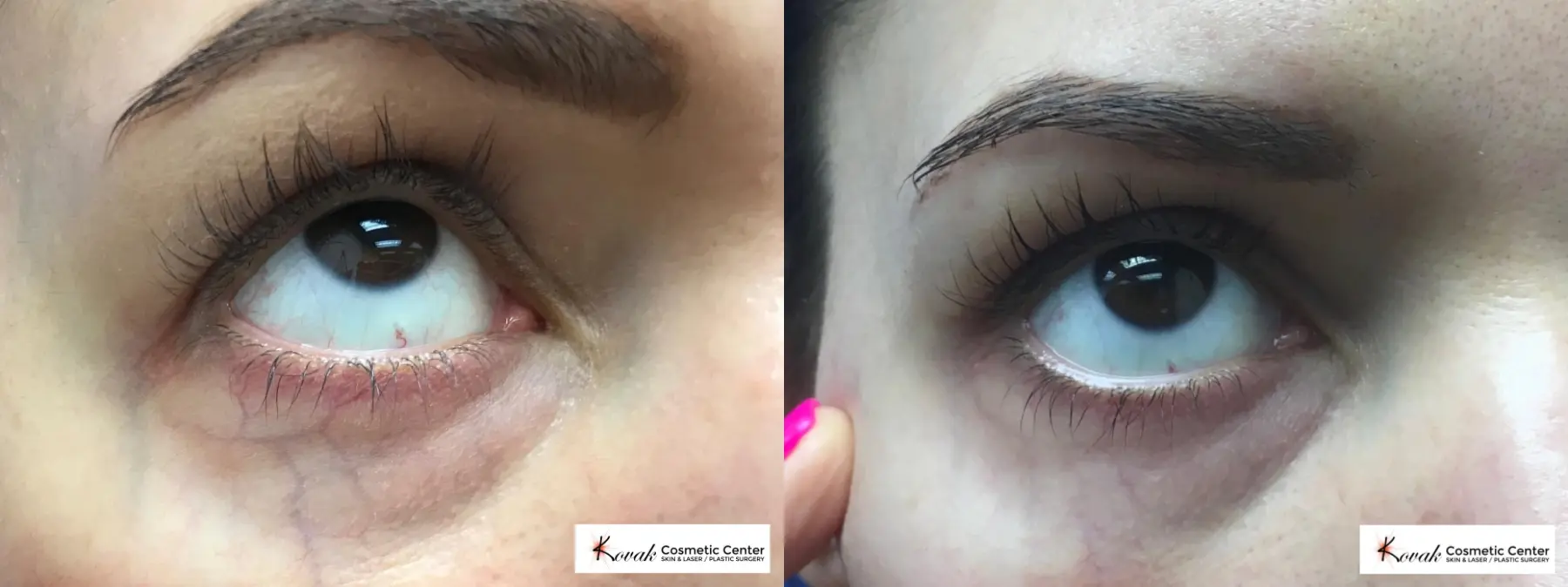 Eye Vein Treatment using the CoolTouch Varia on a 35 year old female - Before and After  