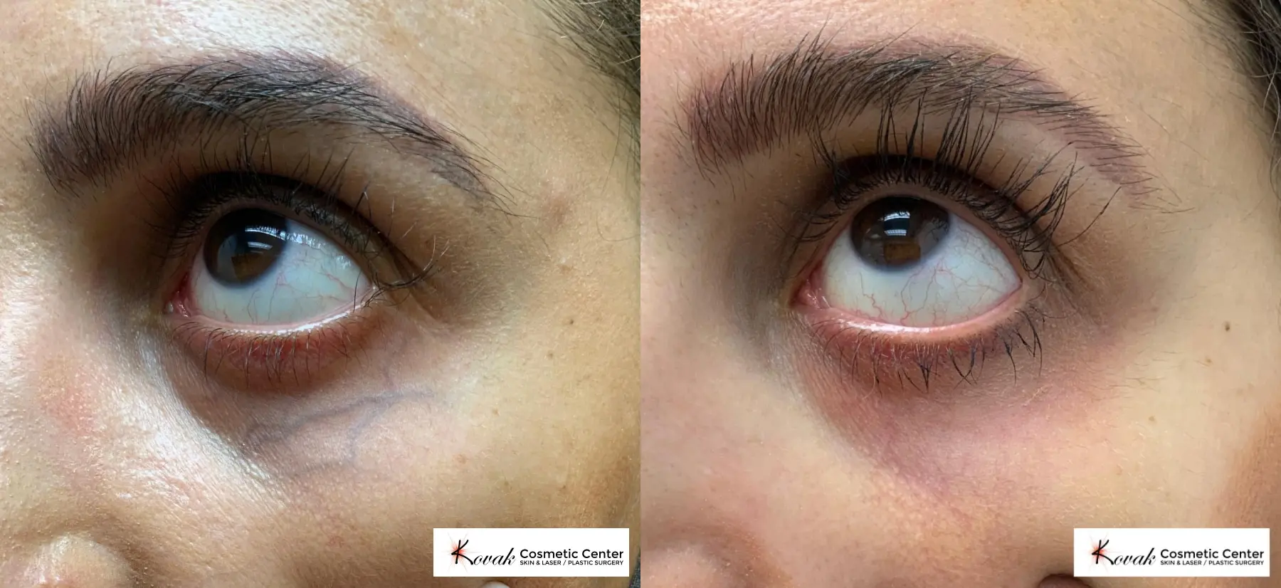 Eye Vein Treatment on a 31 year old female - Before and After  