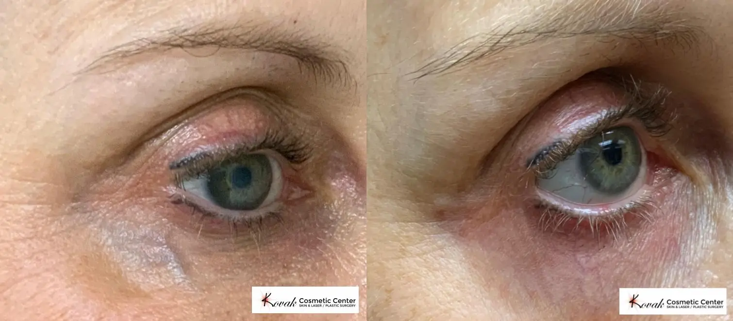 Right Eye Vein treatment using the Varia on a 51 year old female - Before and After  
