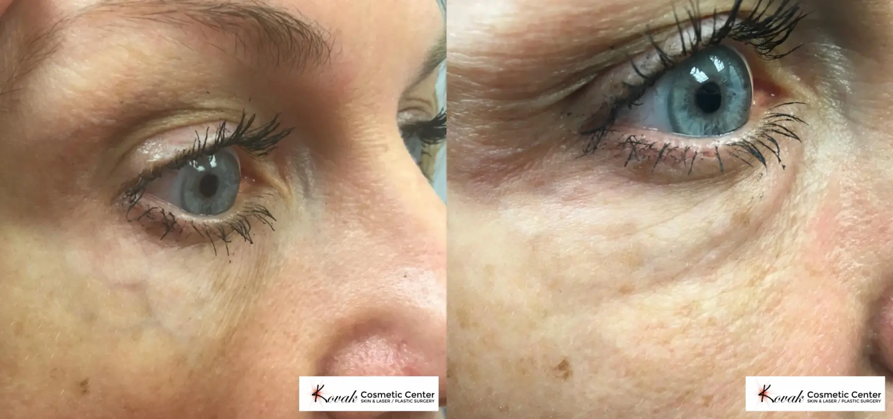 Eye Vein Treatment using the CoolTouch Varia on a 54 year old female - Before and After  