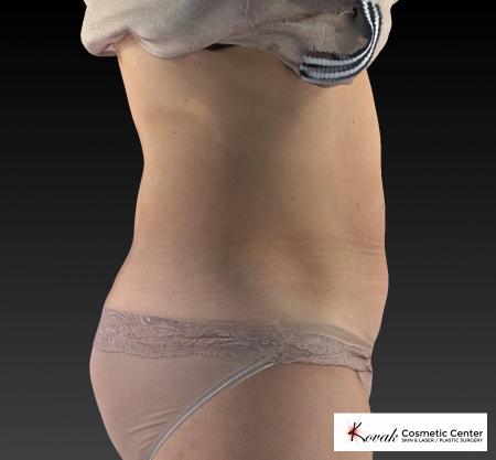 CoolSculpting®: Patient 10 - After 5