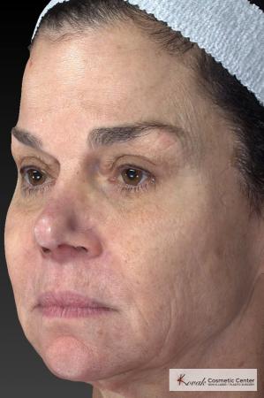 Halo™: Patient 3 - Before 3