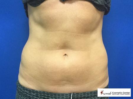 CoolSculpting of the flanks and abdomen on a 50 year old female - Before