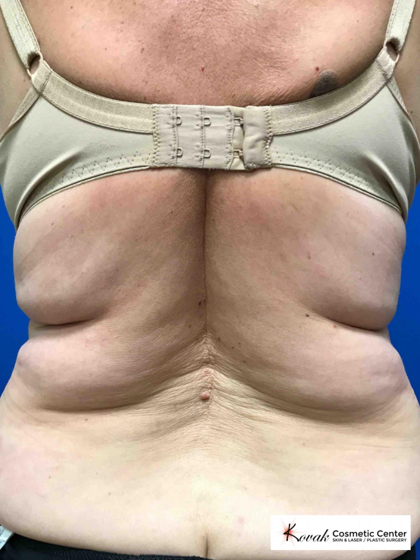 CoolSculpting®: Patient 3 - Before 