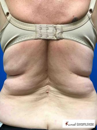 CoolSculpting®: Patient 3 - Before 1