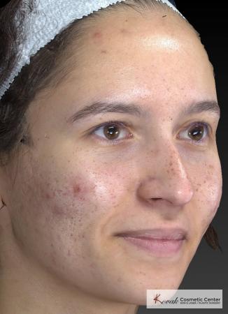 Venus Viva: Patient 3 - Before and After Image 5