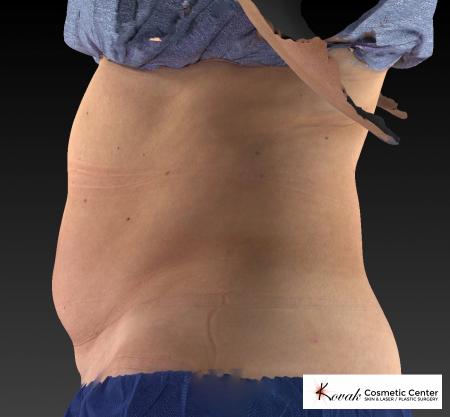 CoolSculpting®: Patient 10 - Before 4