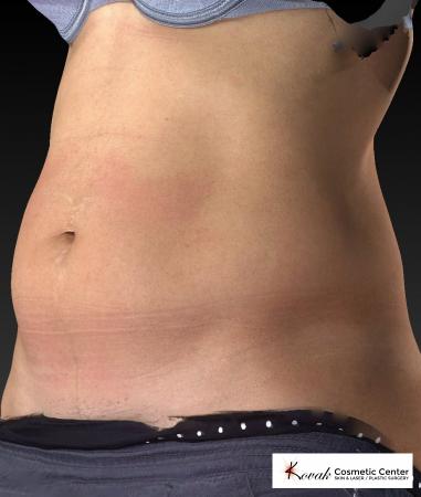 CoolSculpting®: Patient 6 - Before Image 4
