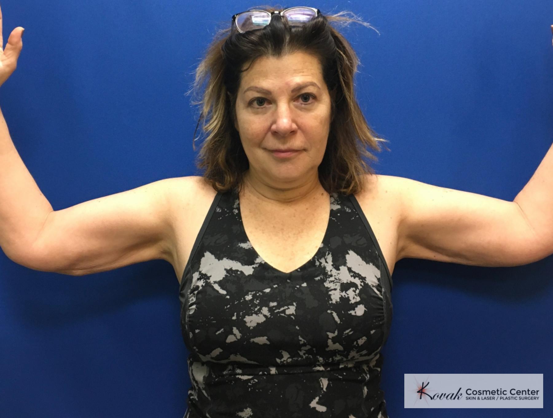 Laser Liposuction: Patient 6 - After  
