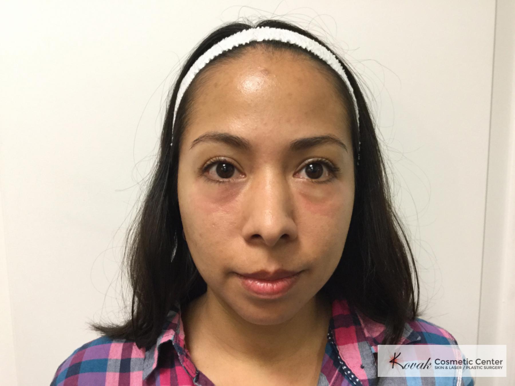 Restylane®: Patient 3 - After  