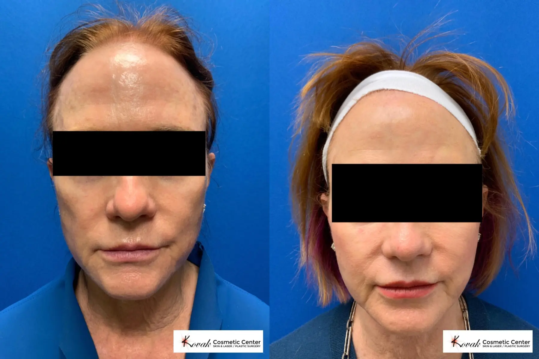 Sculptra treatment on a 70 year old female patient - Before and After  