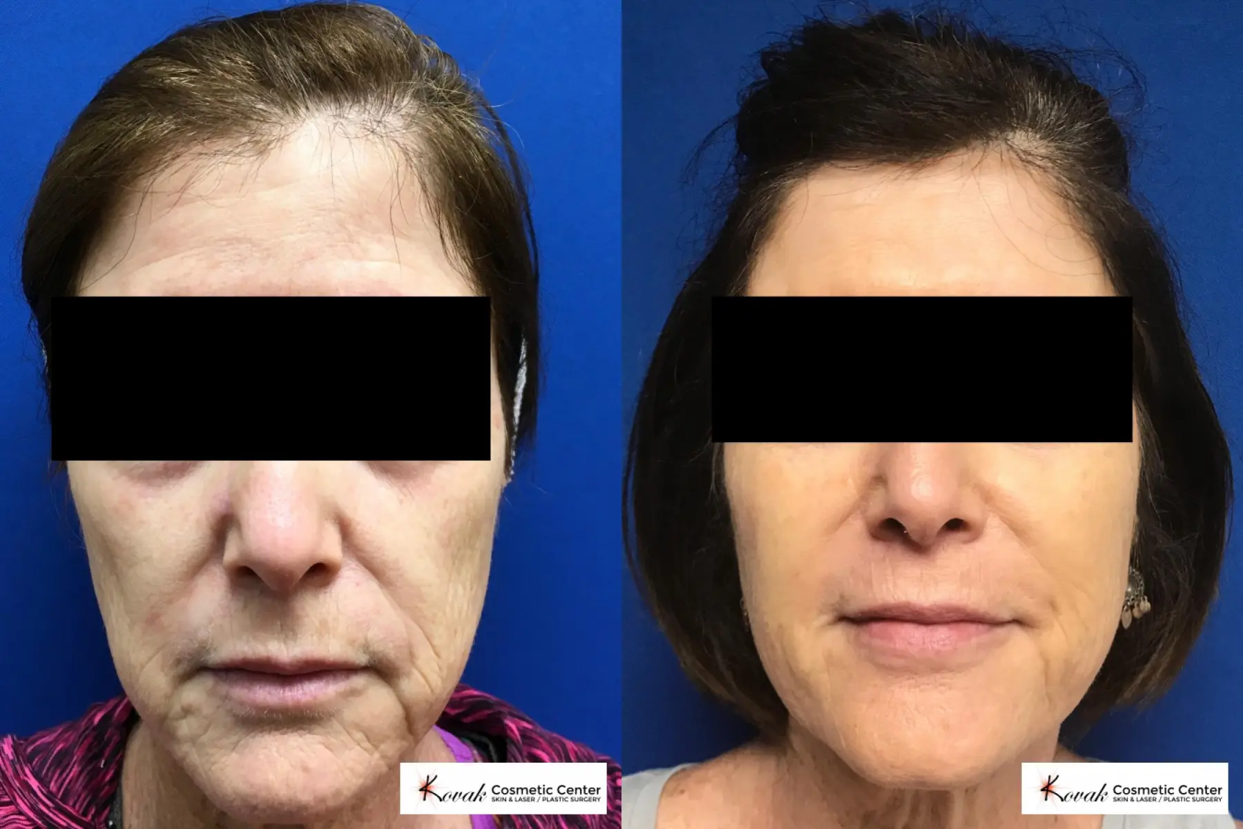 Sculptra treatment to add volume to a 63 year old female - Before and After  