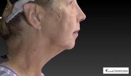 CoolSculpting®: Patient 6 - Before and After Image 3