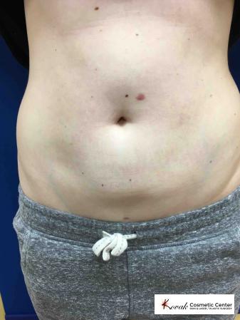 Laser Liposuction of the abdomen on a 28 year old female - After 1