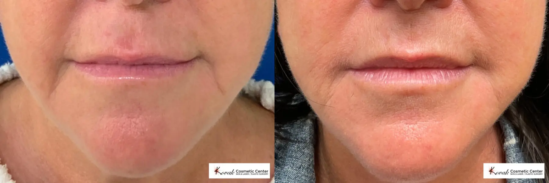 Filler for the corners of the mouth on a 59 yr old female  - Before and After  