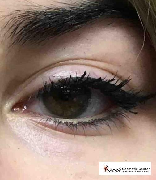 Eye Treatments: Patient 1 - After 2