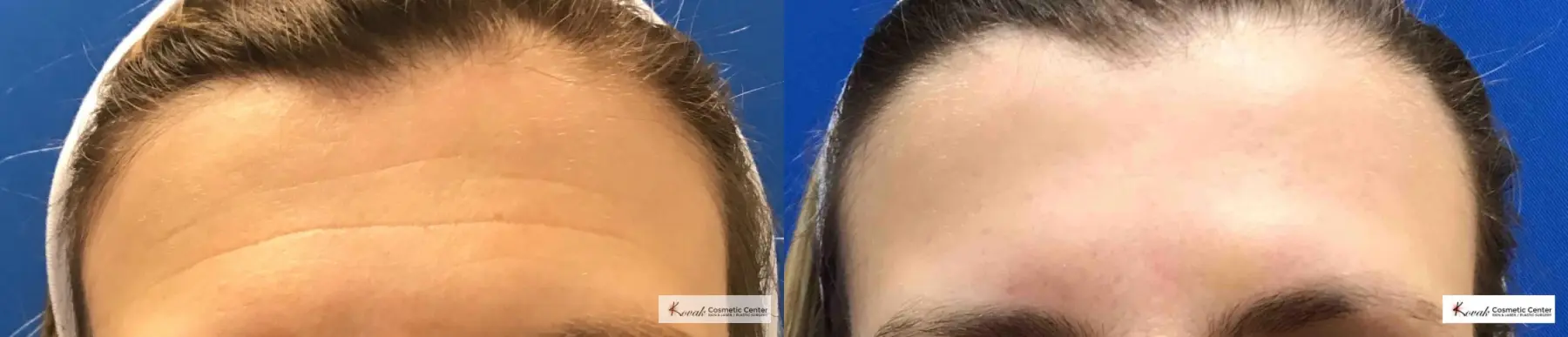 Restylane Silk for Forehead Lines on 43 year old female - Before and After 1