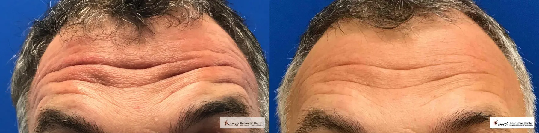 Volbella for Forehead Lines on a 52 year old male - Before and After  