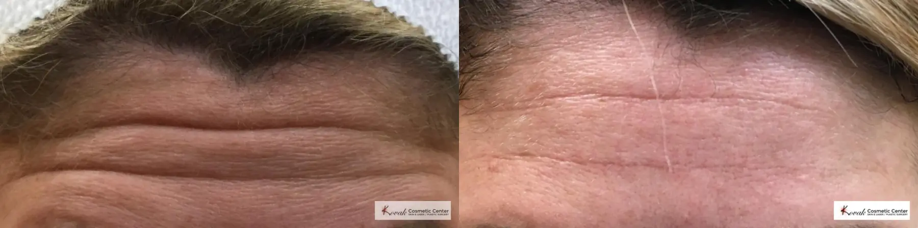 Restylane Silk for Forehead Lines on a 40 year old woman - Before and After  