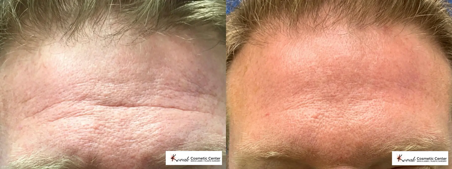 Forehead Lines using Filler on a 46 year old male - Before and After  