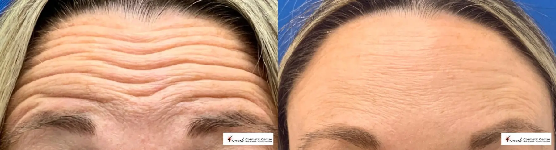 Restylane Silk for Forehead lines on a 35 year old female - Before and After 1
