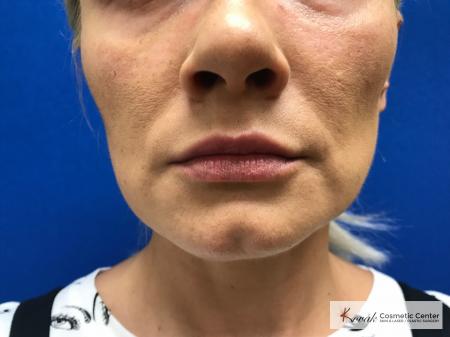 Restylane® Silk: Patient 12 - After 1