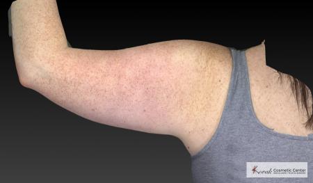 CoolSculpting®: Patient 24 - Before