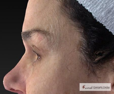 Laser Skin Resurfacing - Face: Patient 2 - Before Image 2