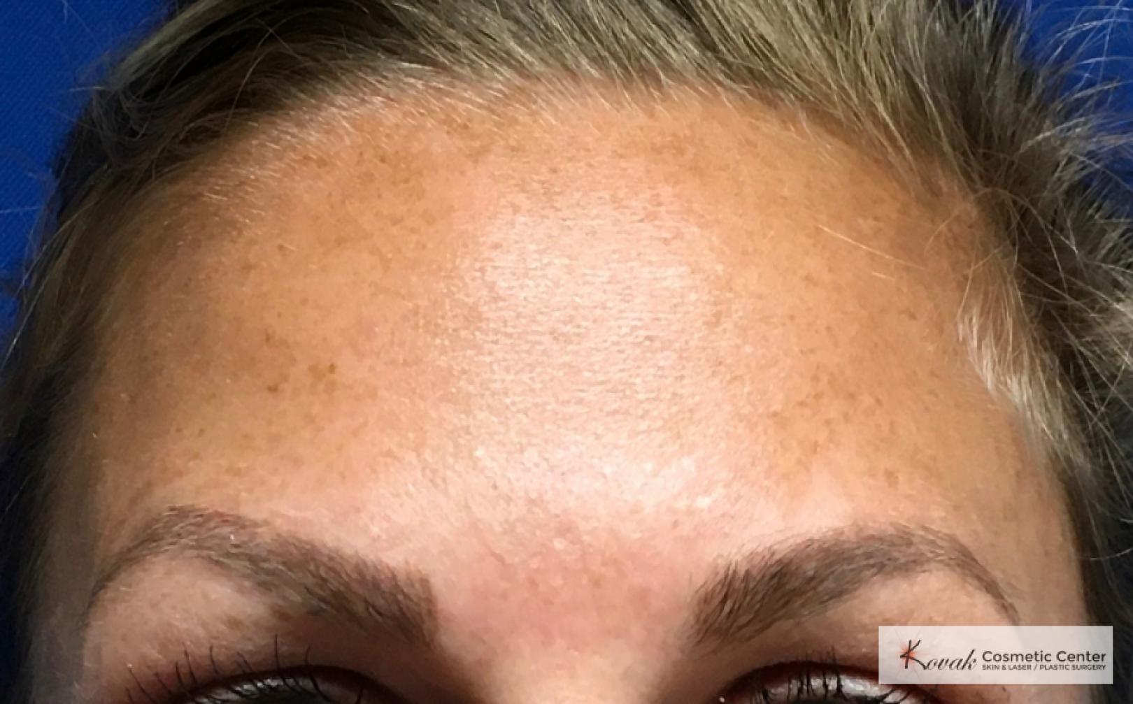 BOTOX® Cosmetic: Patient 7 - After  