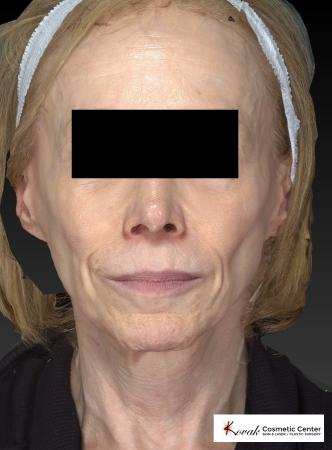 Sculptra®: Patient 1 - Before 1