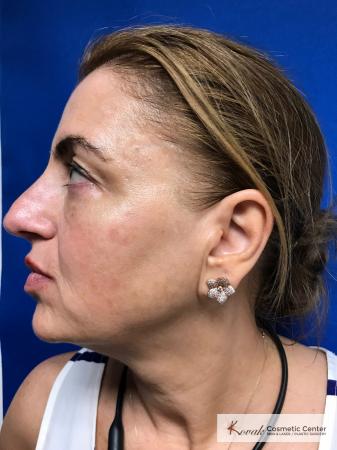 Tyte And Bryte – Face: Patient 2 - After Image 1