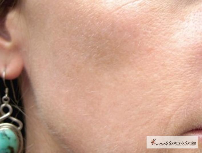 Tyte And Bryte Photorejuvenation: Patient 1 - After  