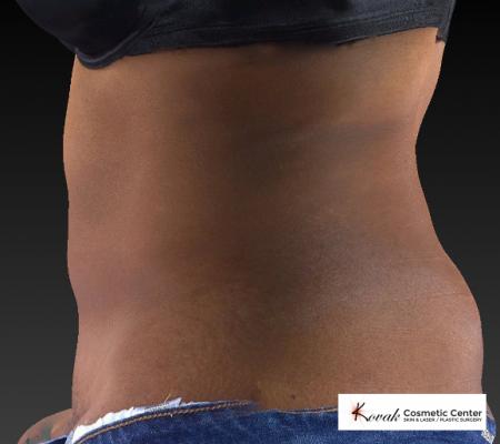 CoolSculpting®: Patient 15 - After 4