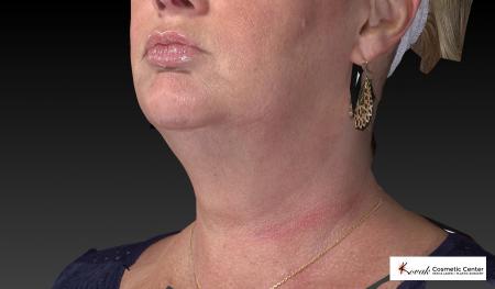 Kybella: Patient 1 - After Image 3