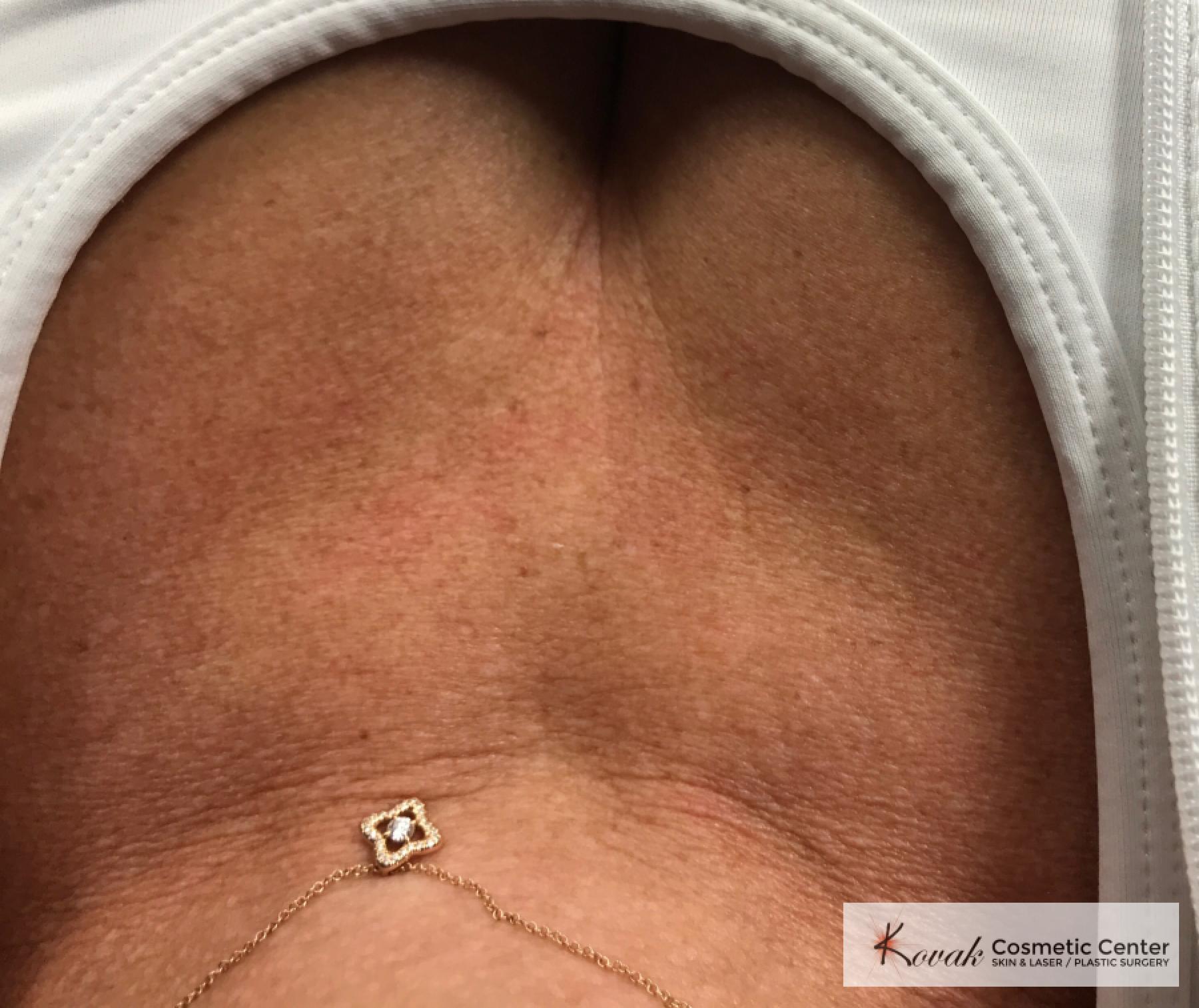 Restylane® Silk: Patient 10 - Before 