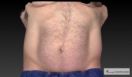 CoolSculpting®: Patient 20 - After 3