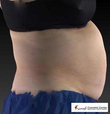 CoolSculpting®: Patient 8 - Before 4
