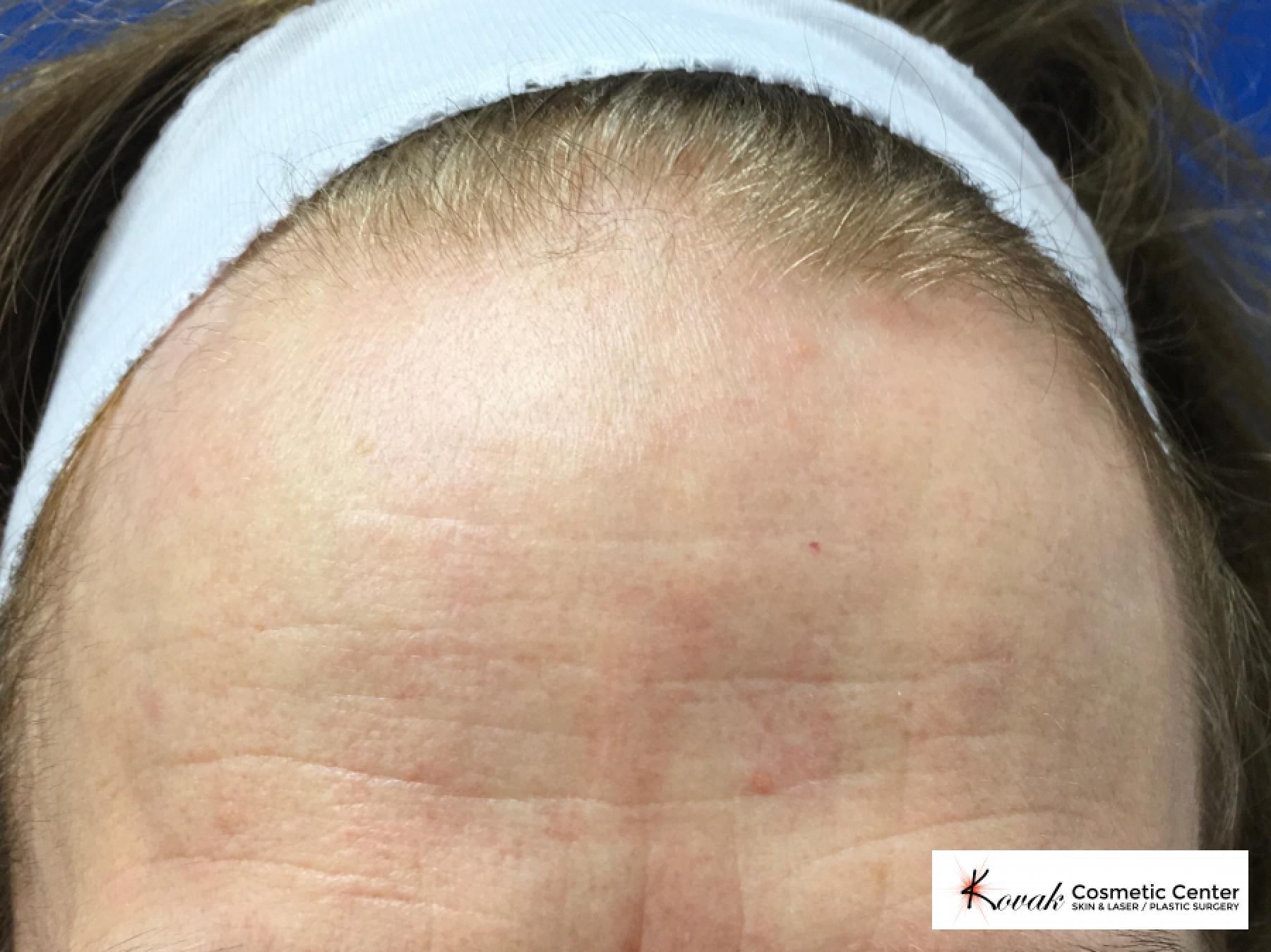 Forehead lines treated with Restylane Silk on 60 year old female - Before 