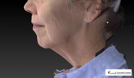 CoolSculpting®: Patient 6 - After Image 2