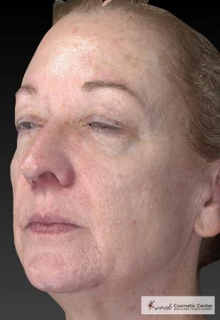 Tyte And Bryte – Face: Patient 6 - After Image 2