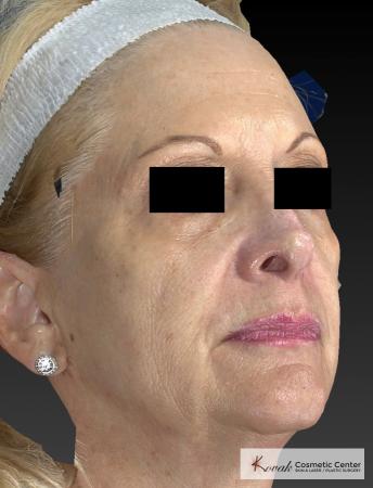 Sculptra®: Patient 5 - Before and After 5