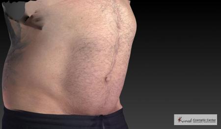 CoolSculpting®: Patient 20 - Before 2