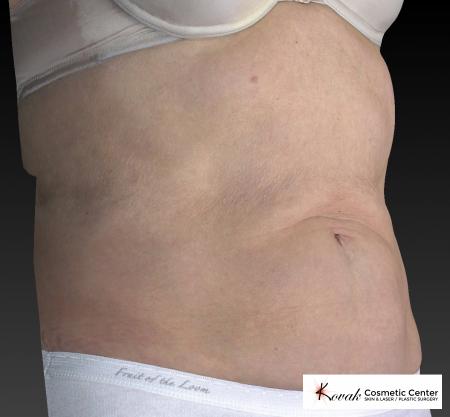 CoolSculpting®: Patient 13 - After 3