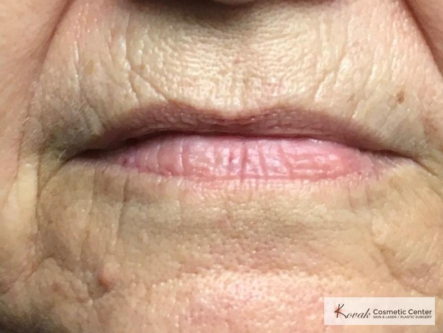 Restylane Silk for lines around the mouth on a 61 year old female - Before 