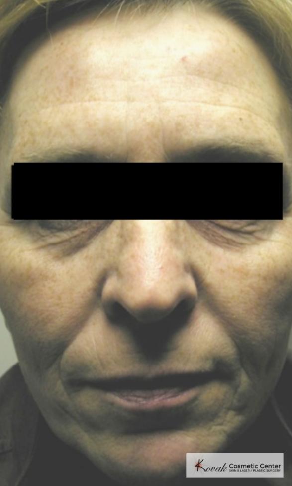 Tyte & Bryte Photorejuvenation of the face on 63 year old family - Before 1