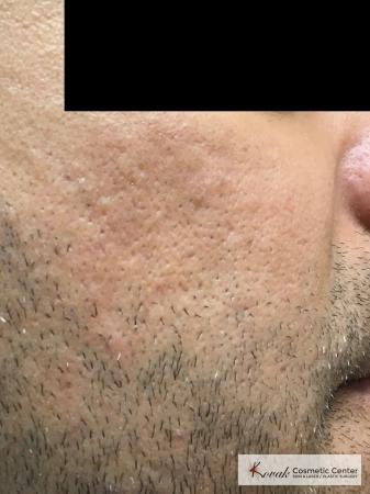 Acne Scars treated with Juvederm and Venus Viva on 35 year old male - After Image 2
