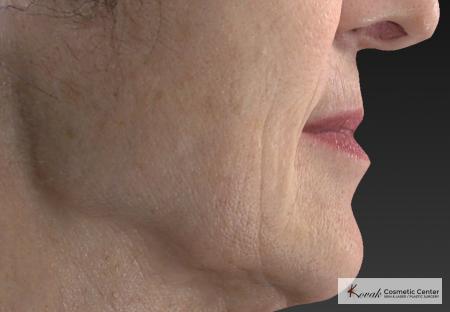 Injectables - Mouth: Patient 8 - Before Image 2